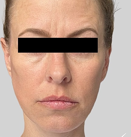 Facelift Neck Lift Before & After