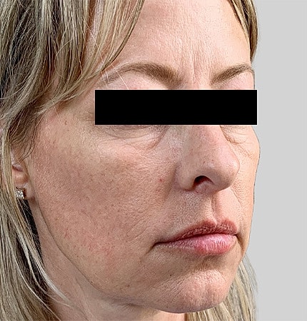 Facelift Neck Lift Before & After