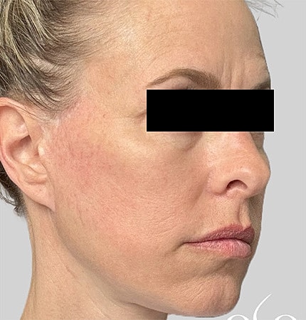 Facelift Neck Lift Before & After