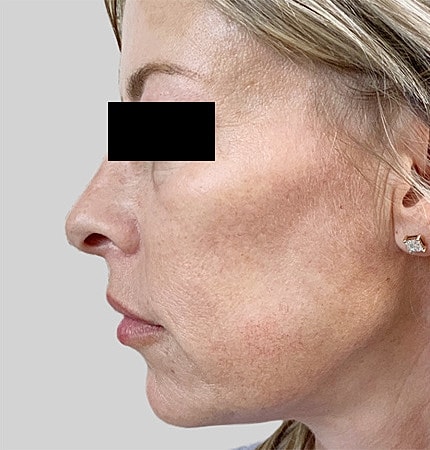 Facelift Neck Lift Before & After