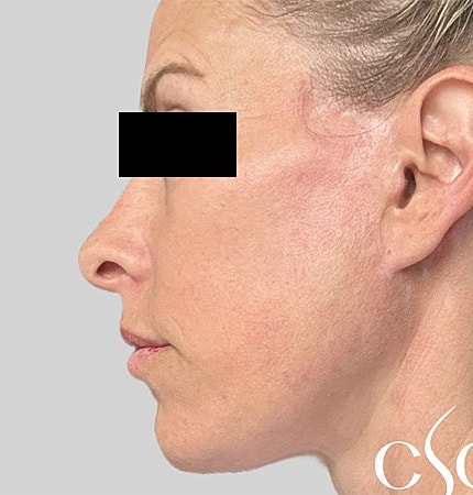 Facelift Neck Lift Before & After