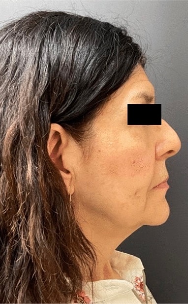Facelift Neck Lift Before & After
