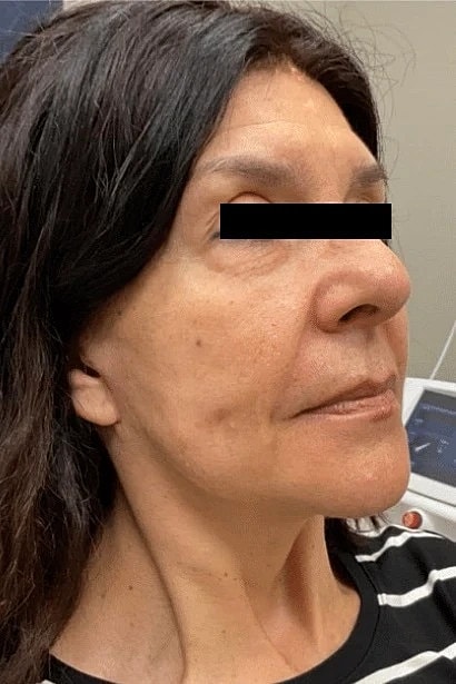 Facelift Neck Lift Before & After