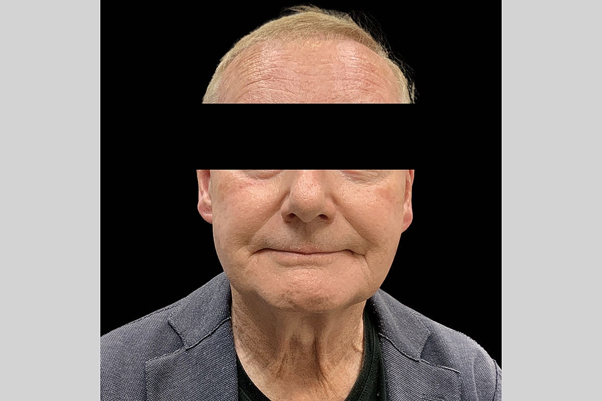 Facelift Neck Lift Before & After