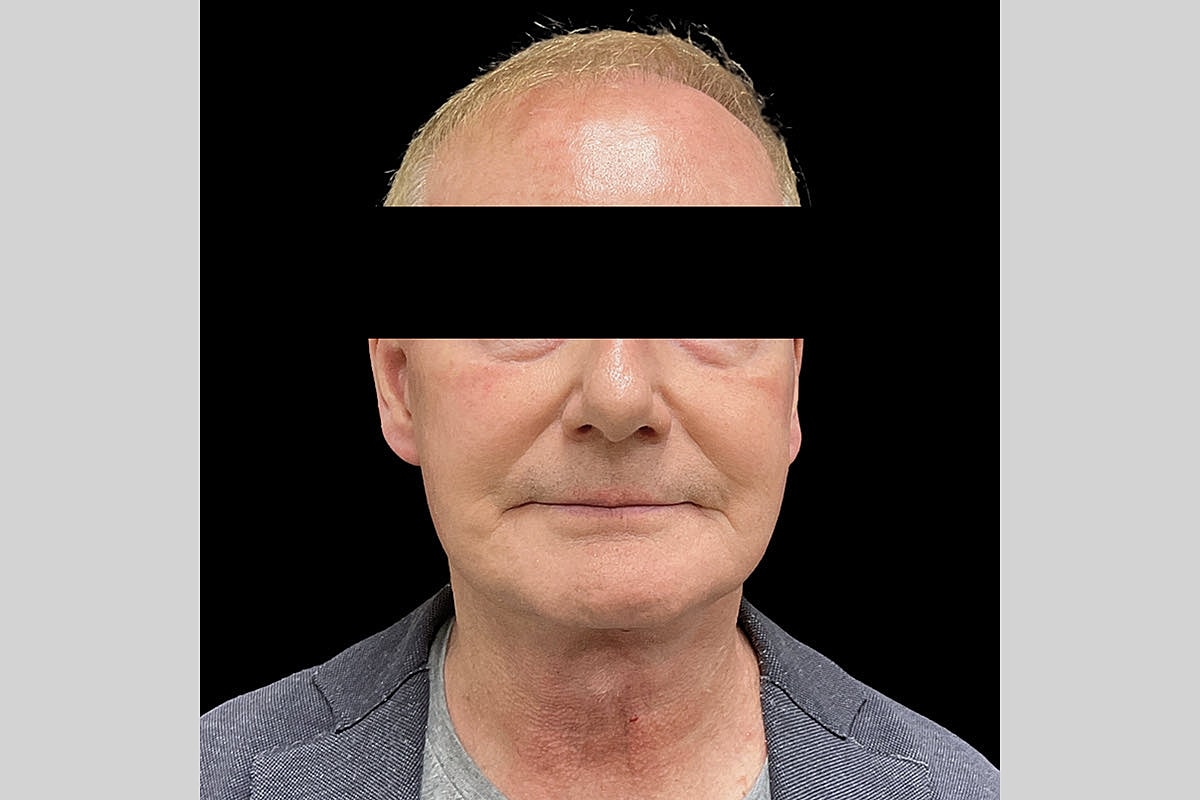 Facelift Neck Lift Before & After