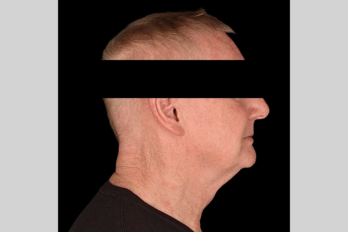 Facelift Neck Lift Before & After