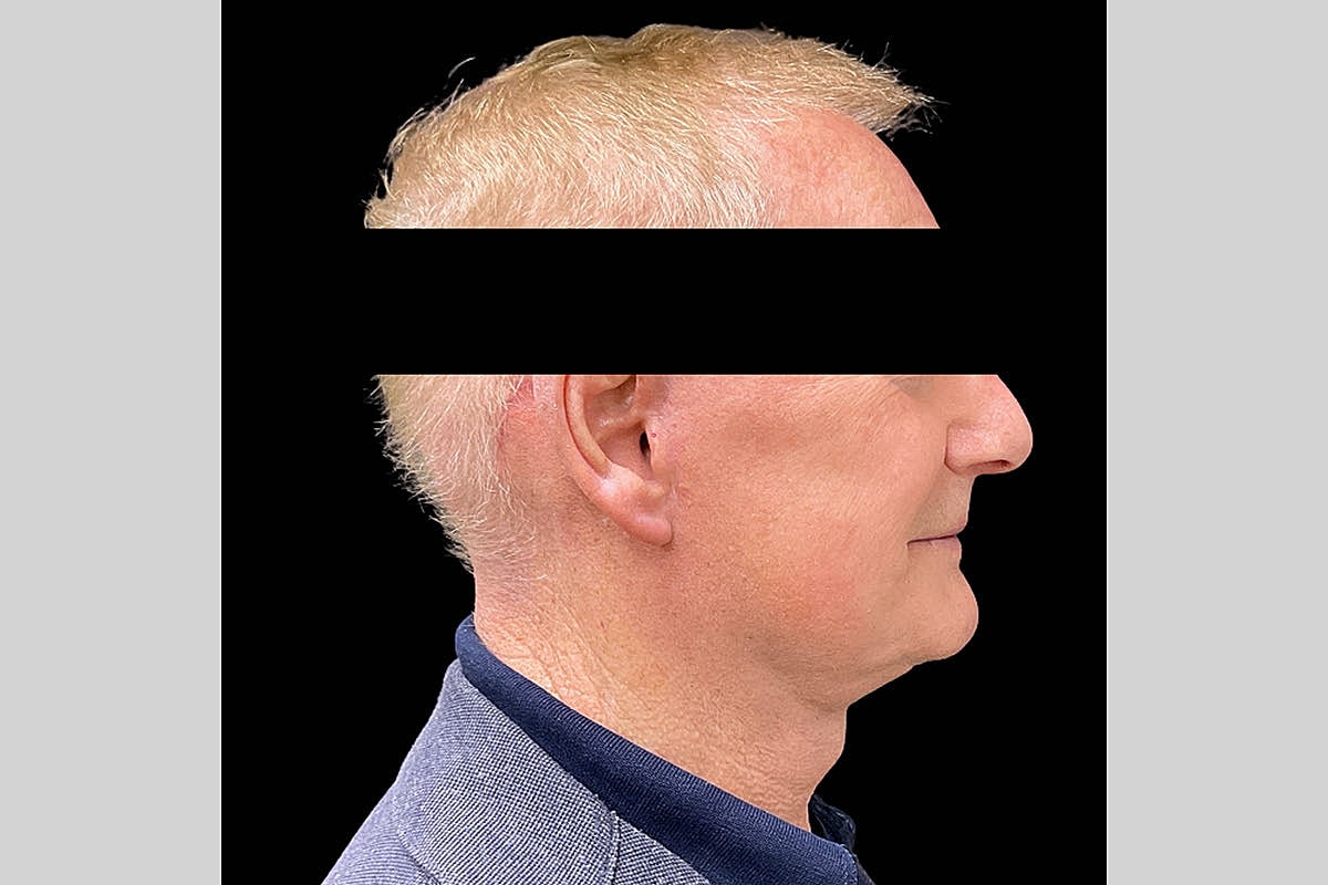 Facelift Neck Lift Before & After