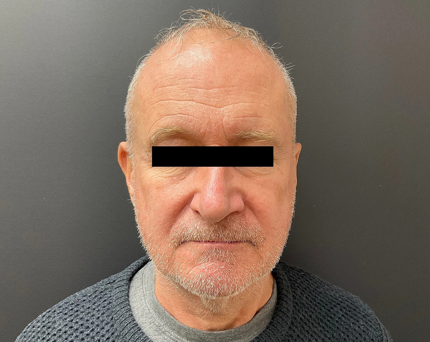 Facelift Neck Lift Before & After