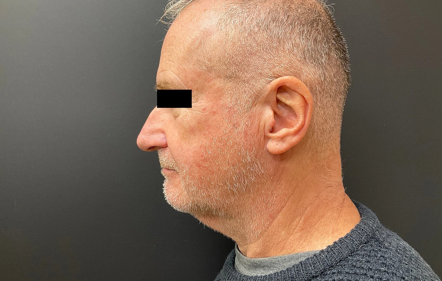 Facelift Neck Lift Before & After