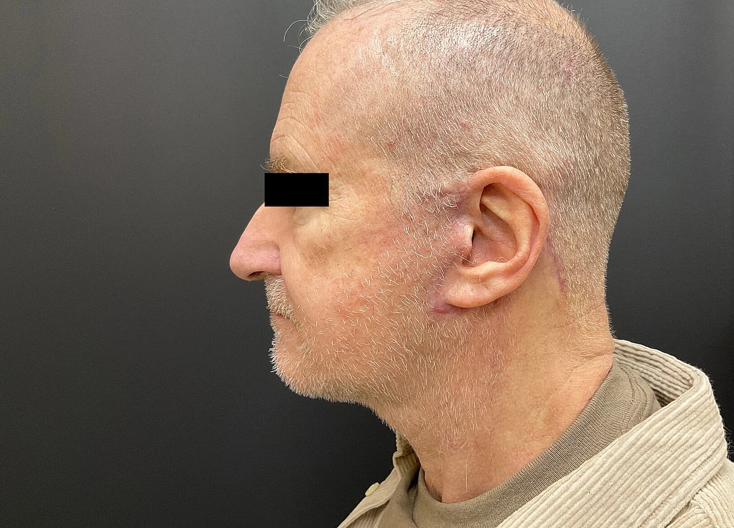 Facelift Neck Lift Before & After