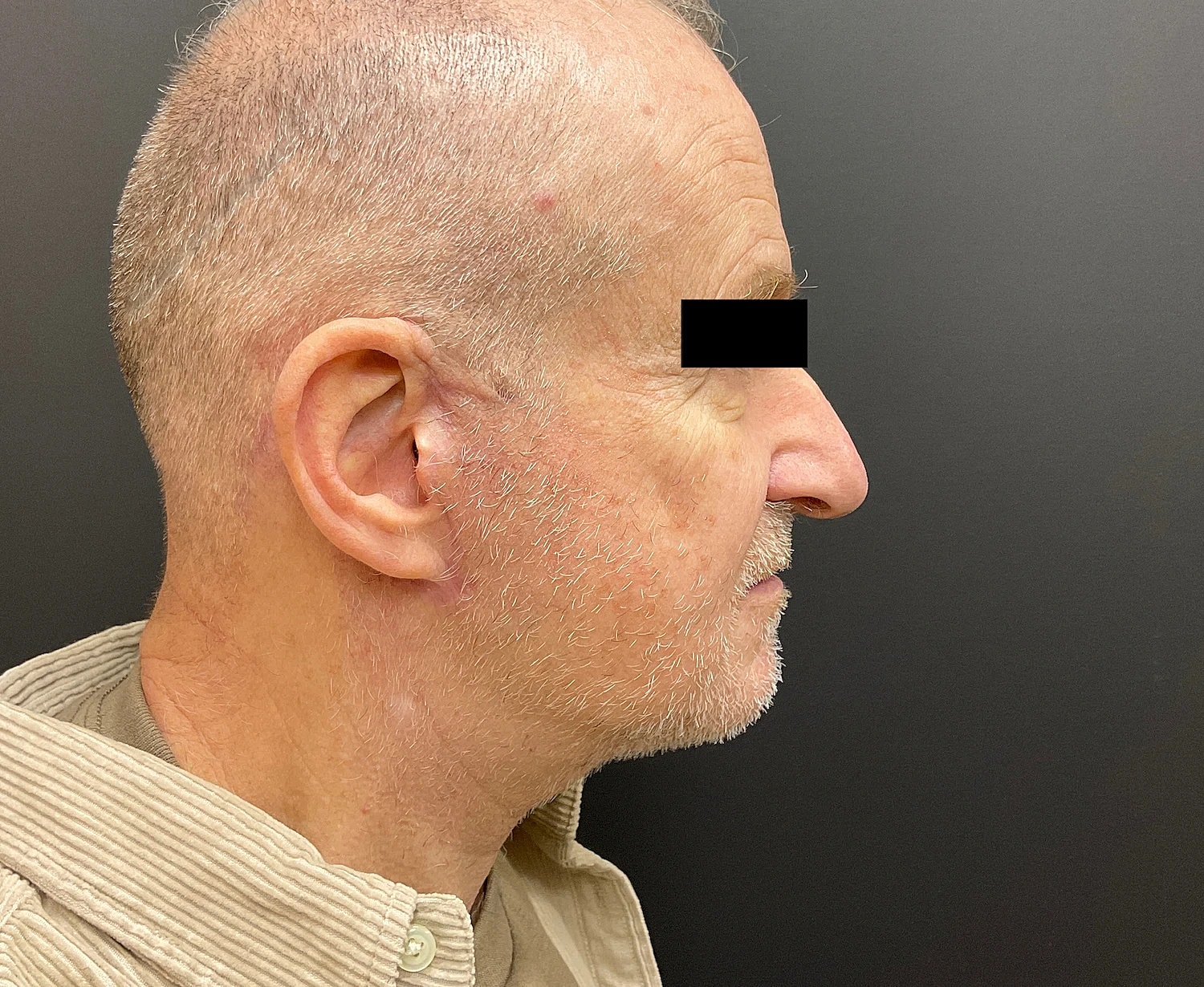 Facelift Neck Lift Before & After