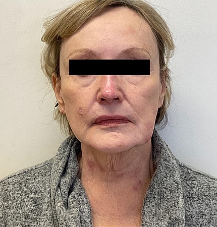 Facelift Neck Lift Before & After