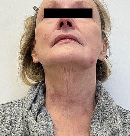 Facelift Neck Lift Before & After