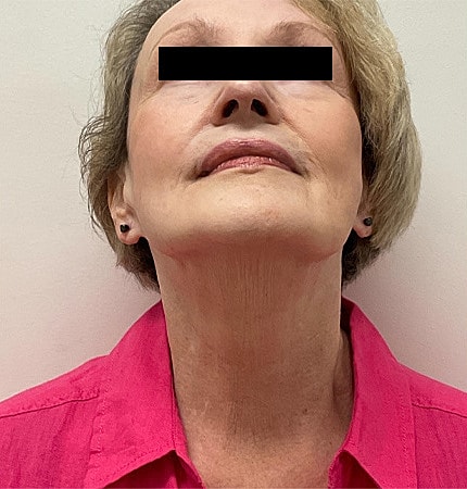 Facelift Neck Lift Before & After