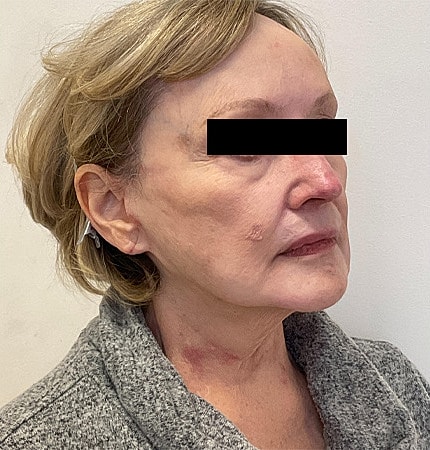 Facelift Neck Lift Before & After