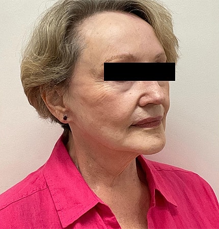 Facelift Neck Lift Before & After