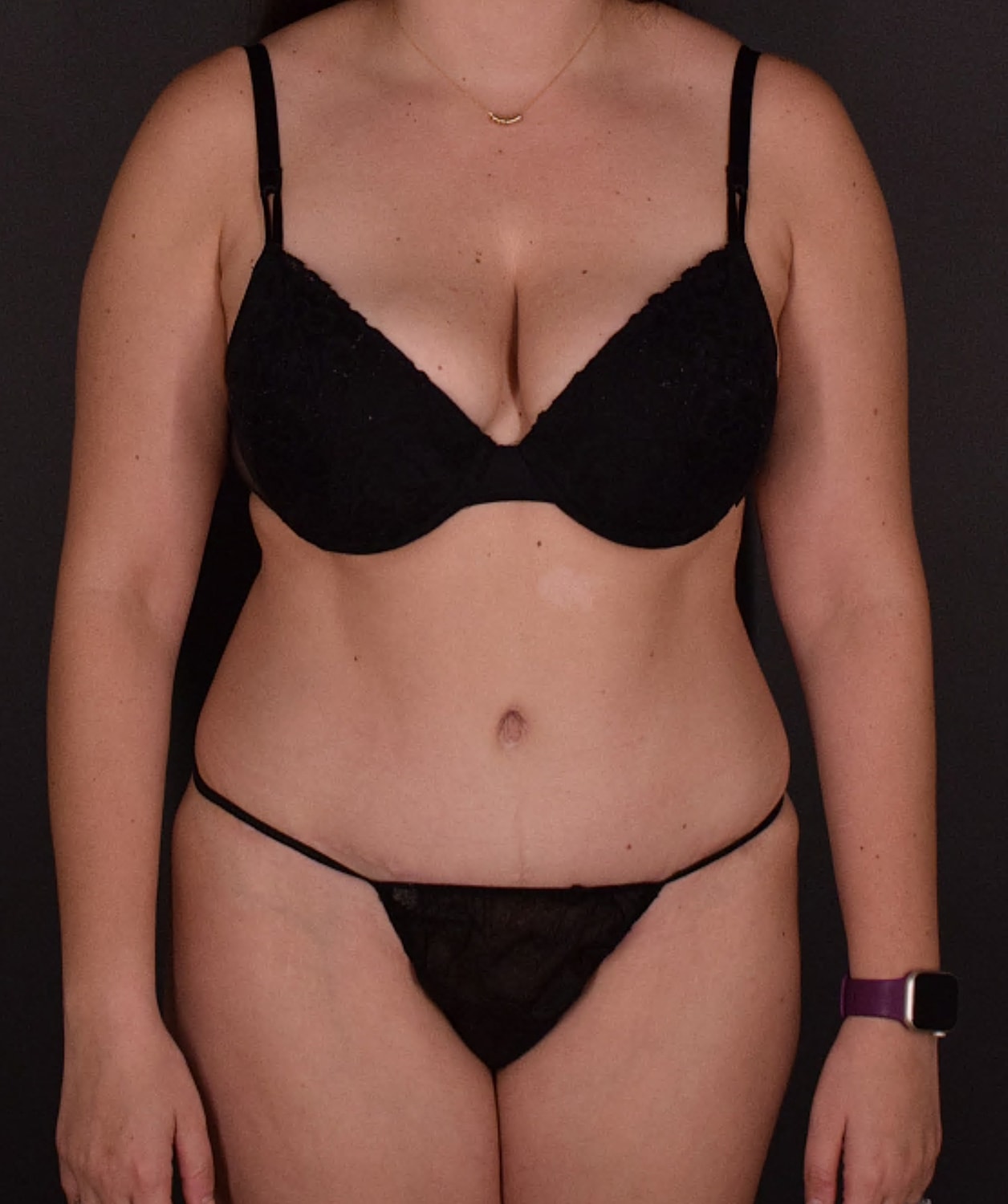 Liposuction Before & After