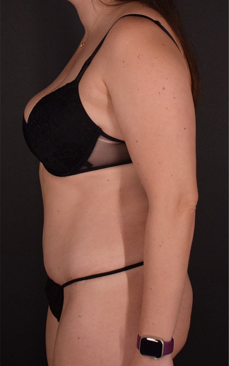 Liposuction Before & After