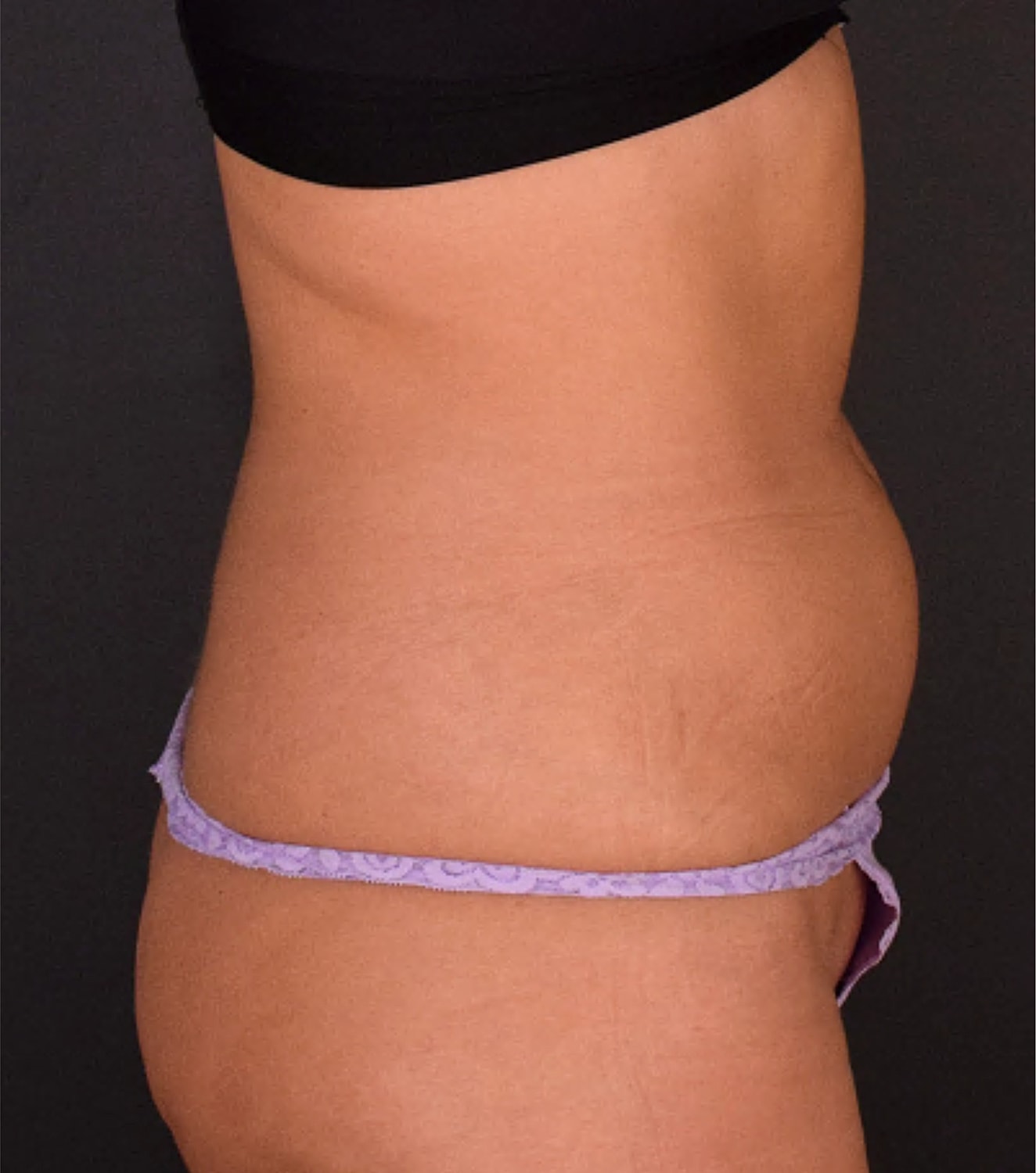 Liposuction Before & After