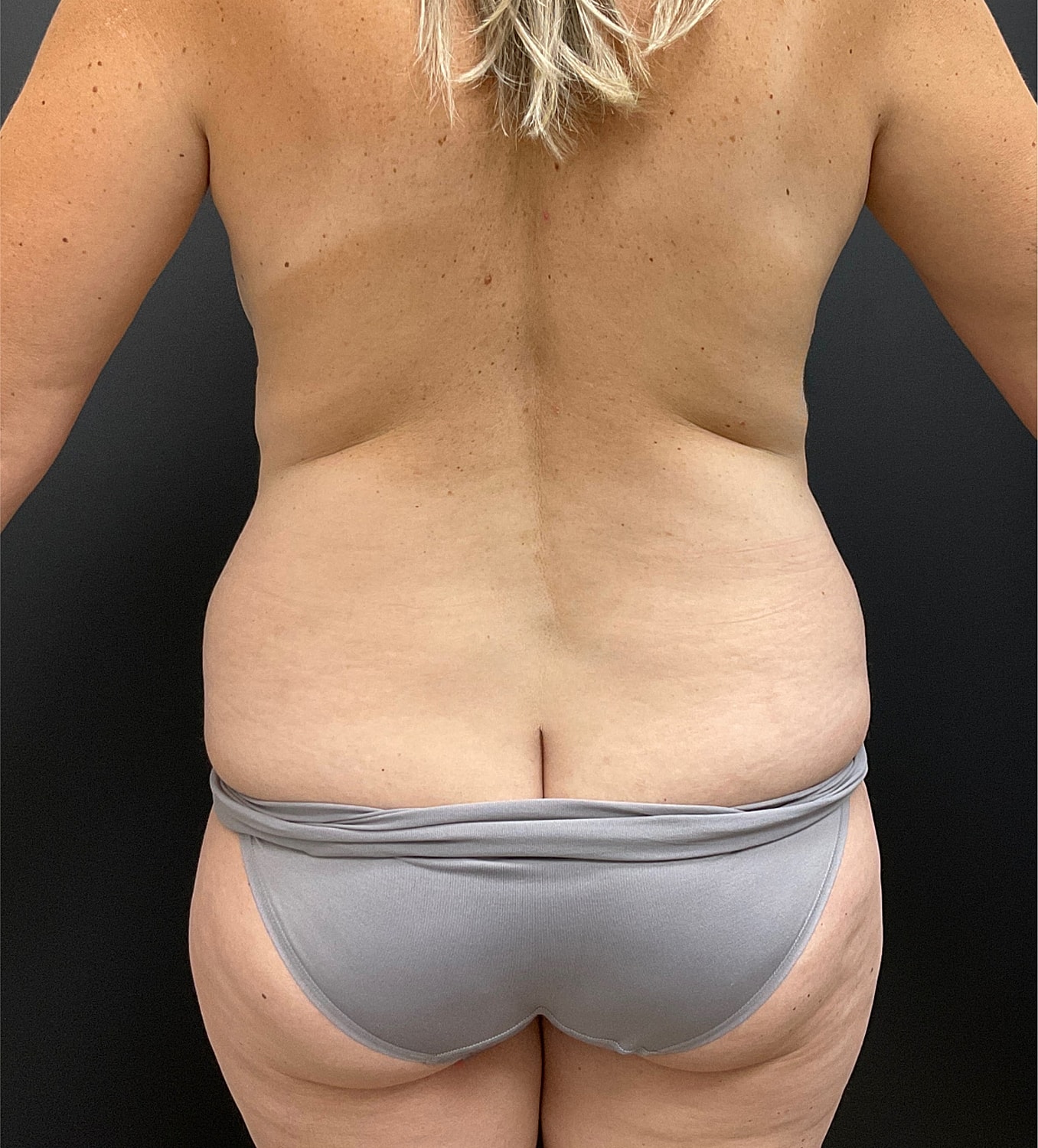 Liposuction Before & After