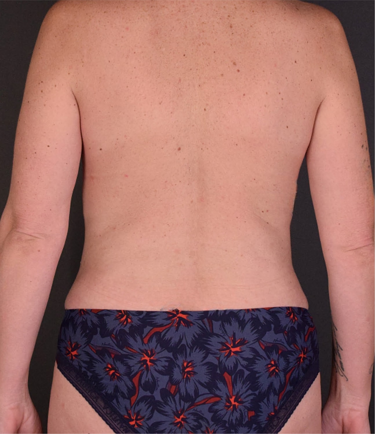 Liposuction Before & After