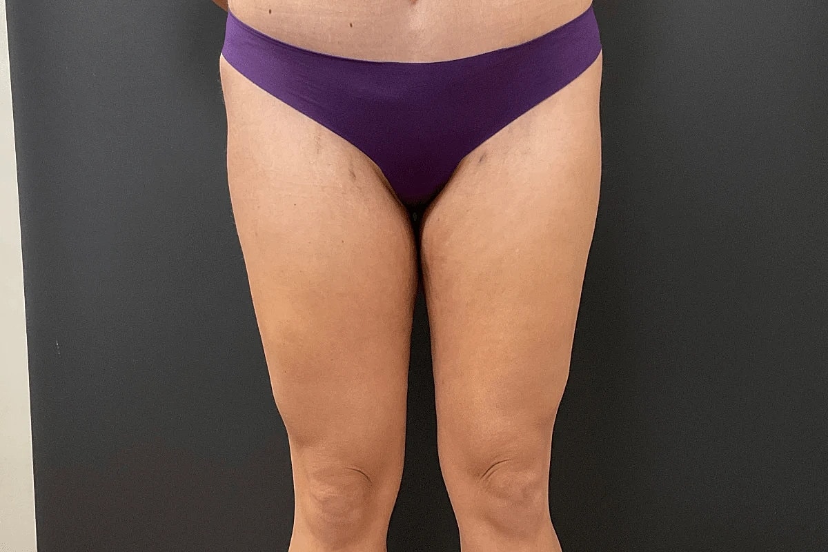 Liposuction Before & After