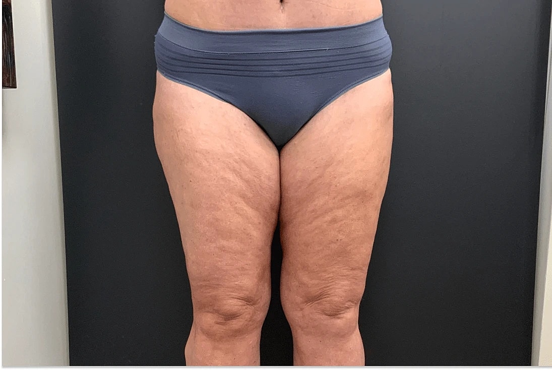 Liposuction Before & After