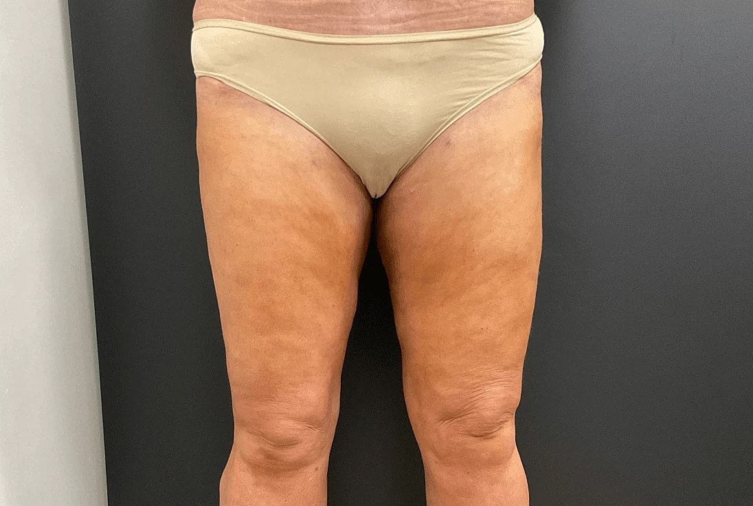 Liposuction Before & After