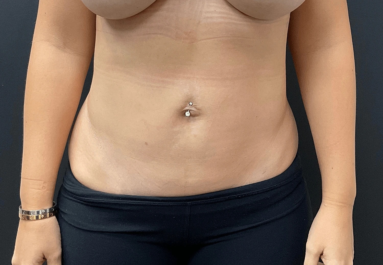 Liposuction Before & After