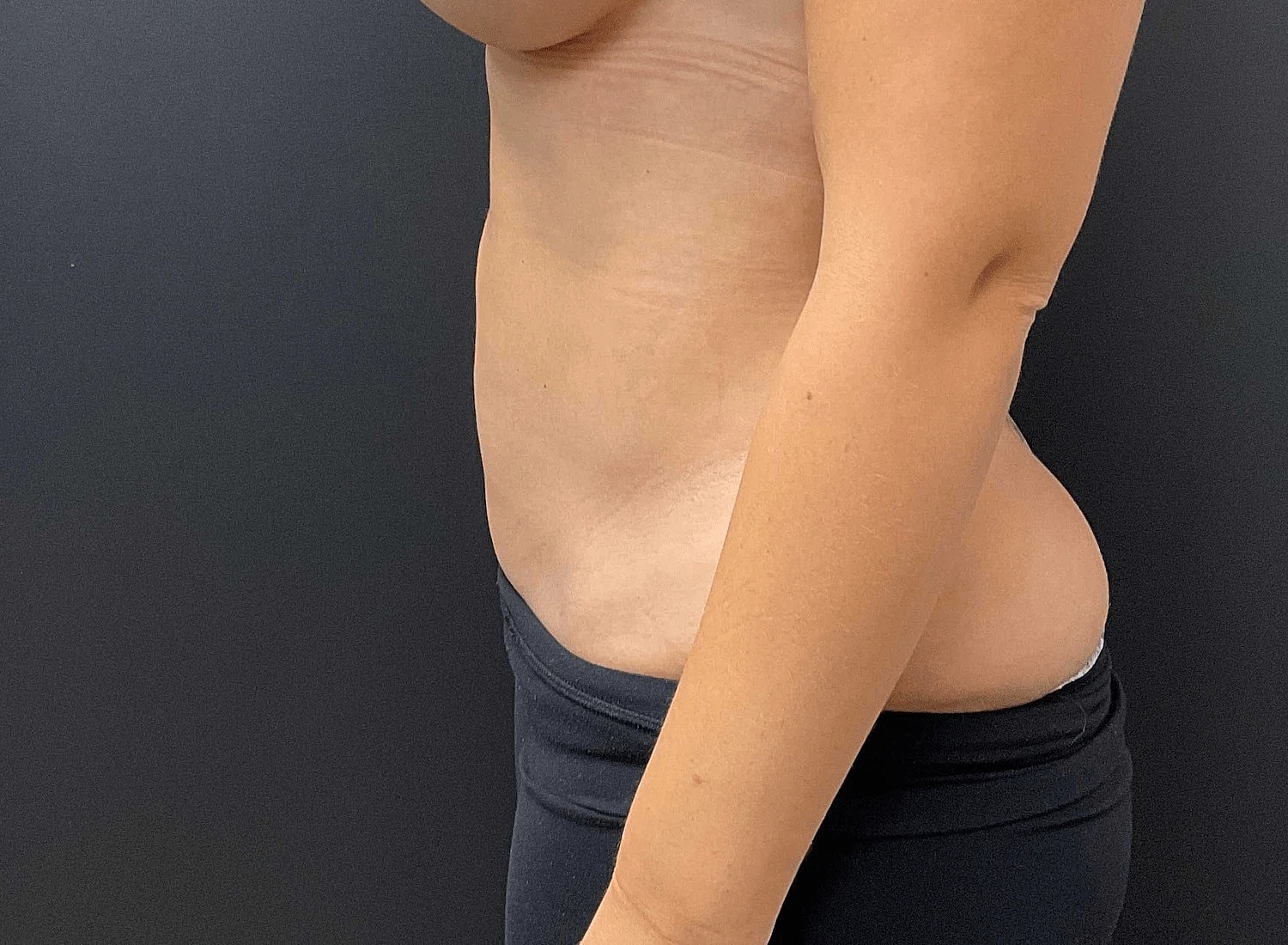 Liposuction Before & After