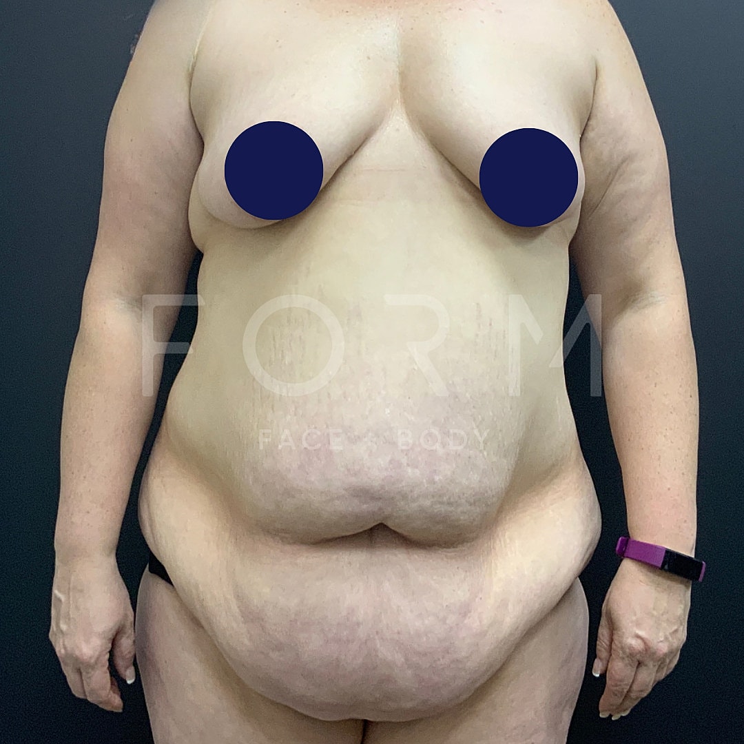 Post Weight Loss Before & After