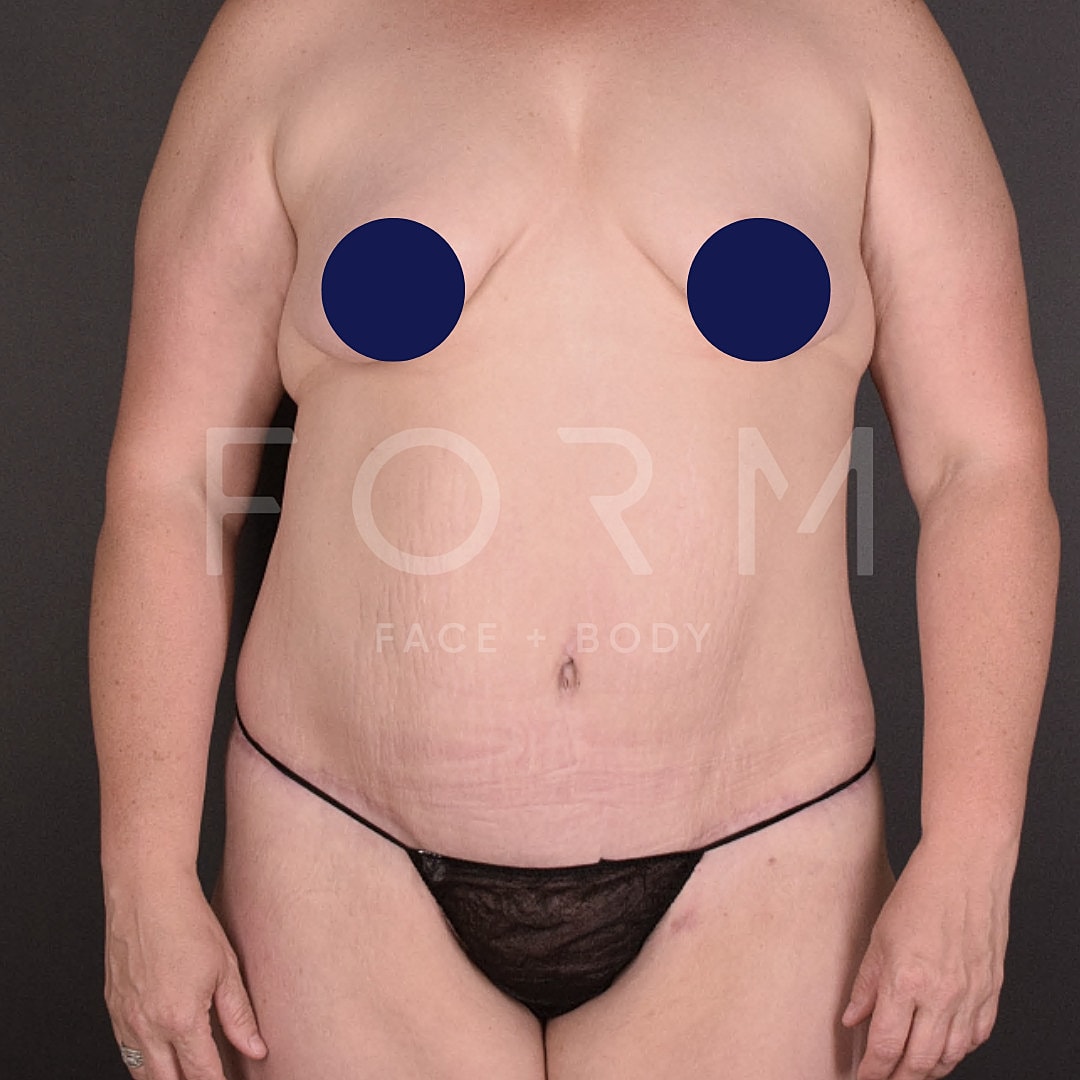 Post Weight Loss Before & After