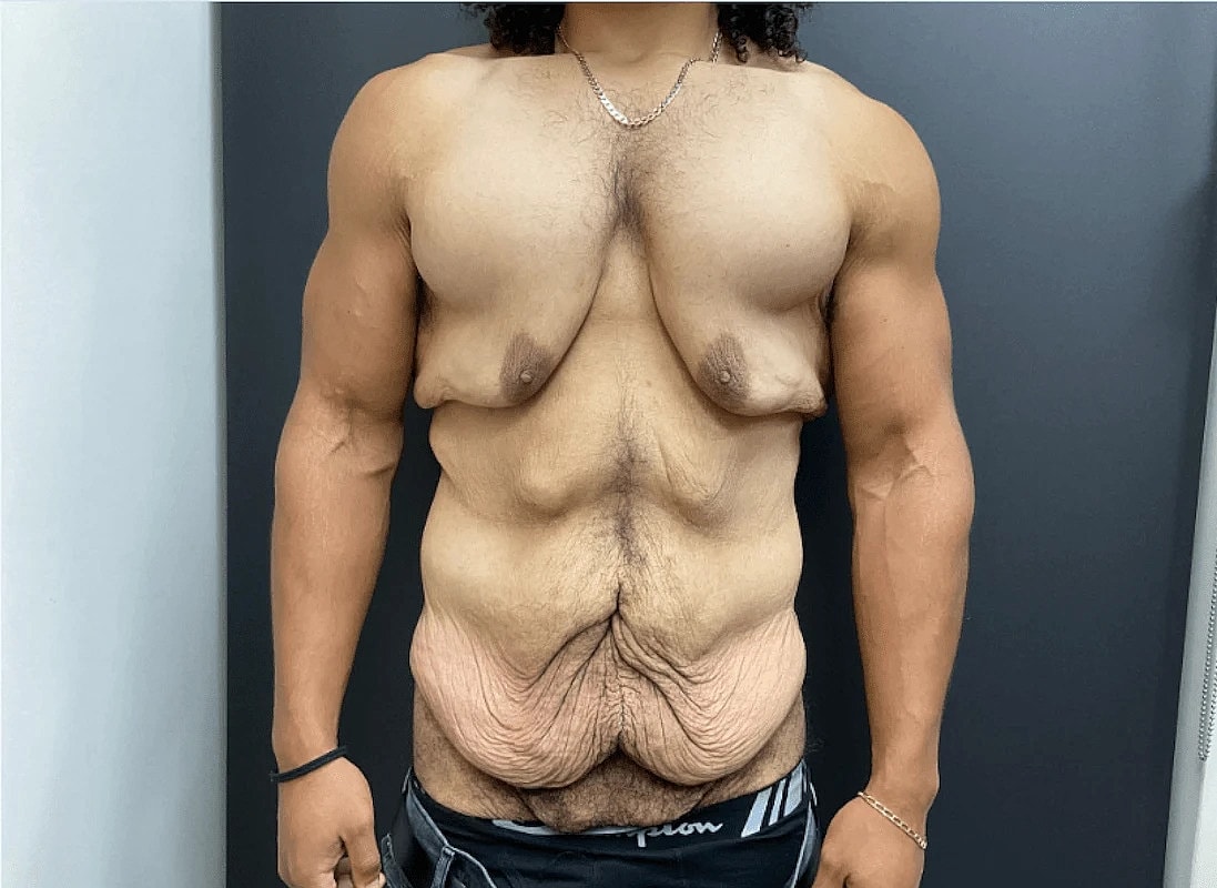 Post Weight Loss Before & After