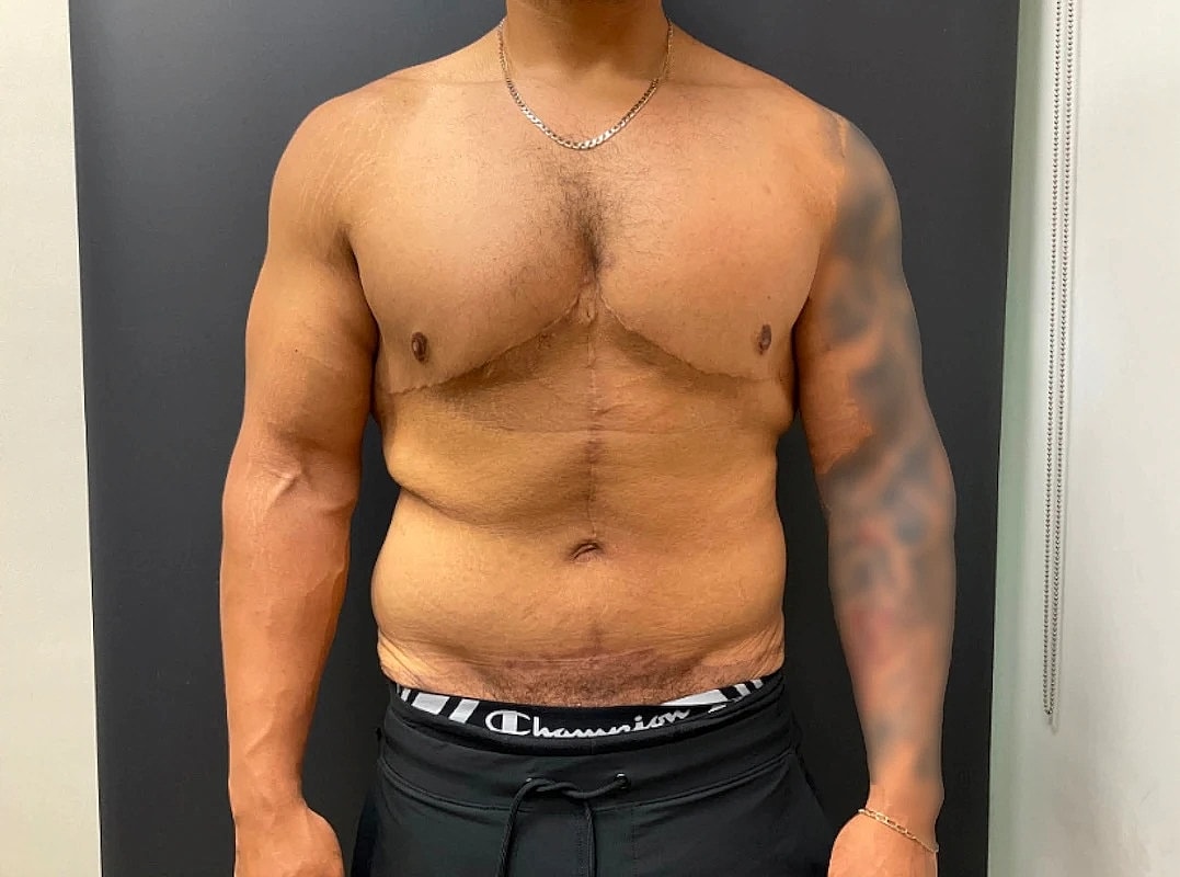 Post Weight Loss Before & After