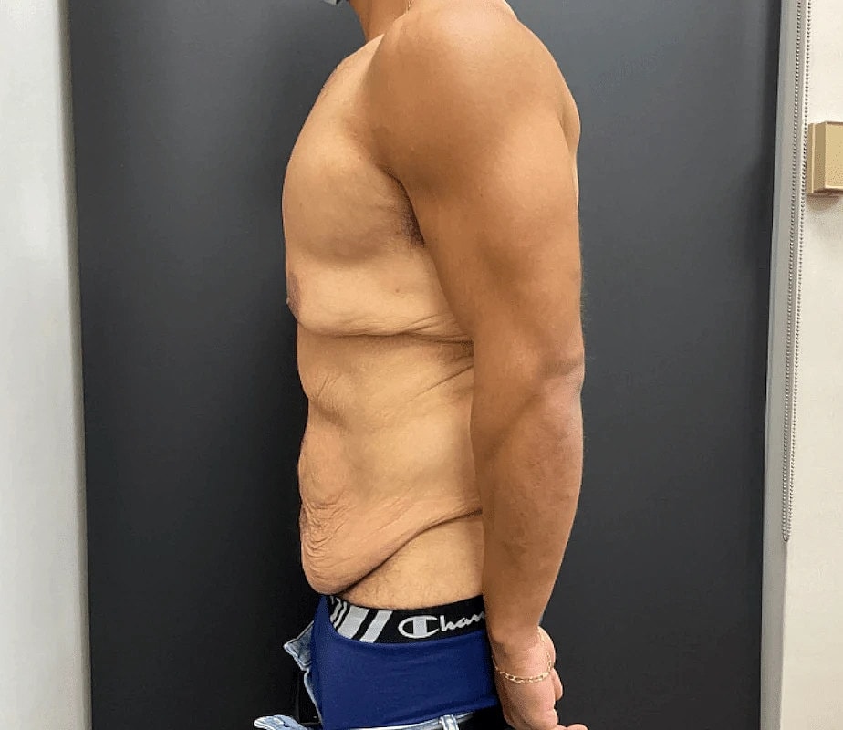 Post Weight Loss Before & After
