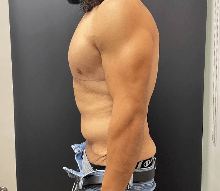 Post Weight Loss Before & After