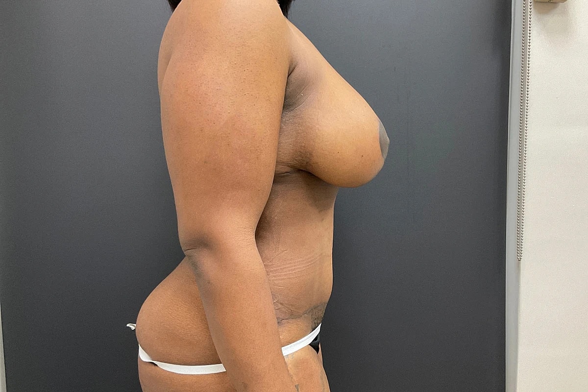 Post Weight Loss Before & After