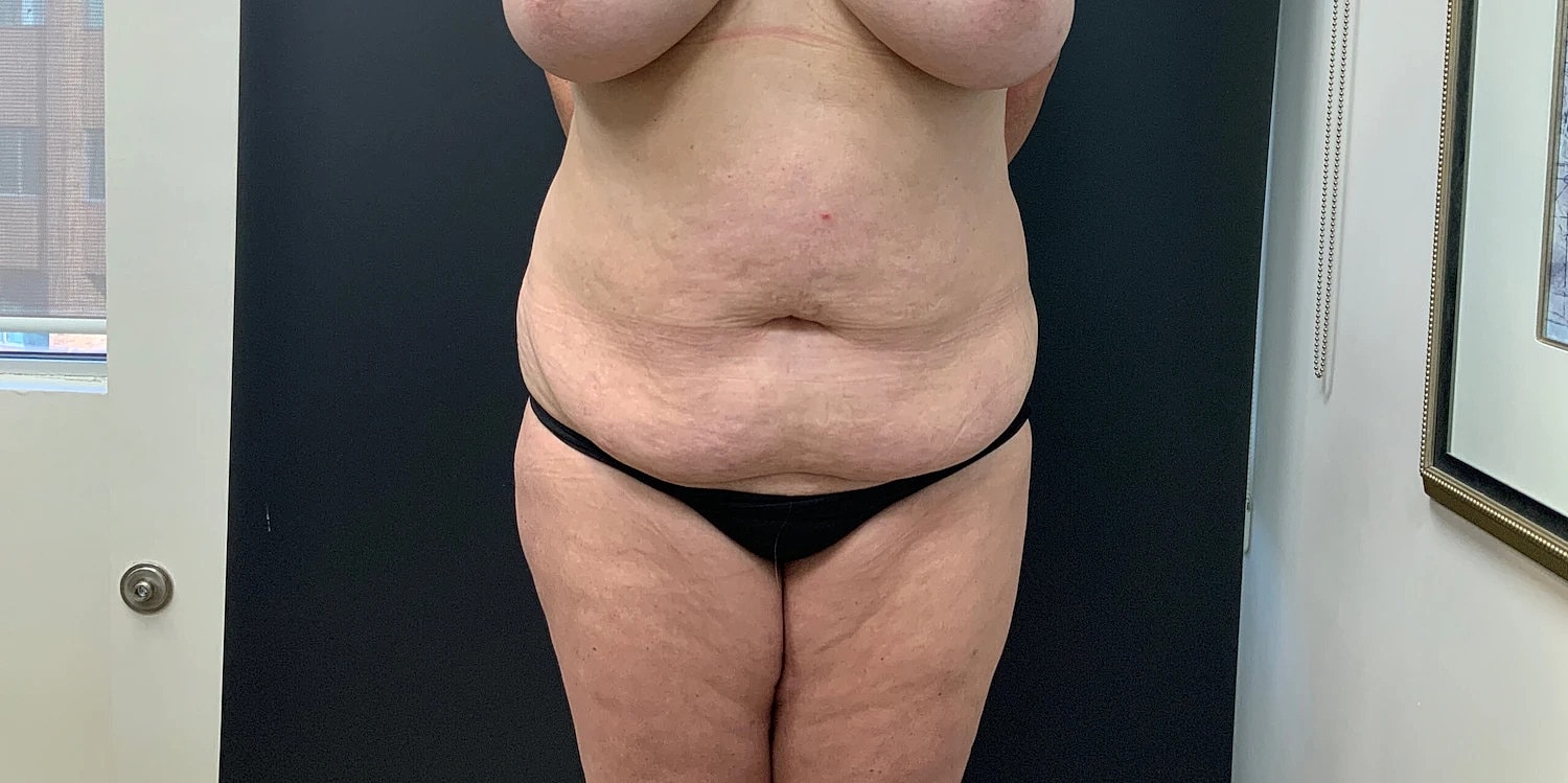 Post Weight Loss Before & After