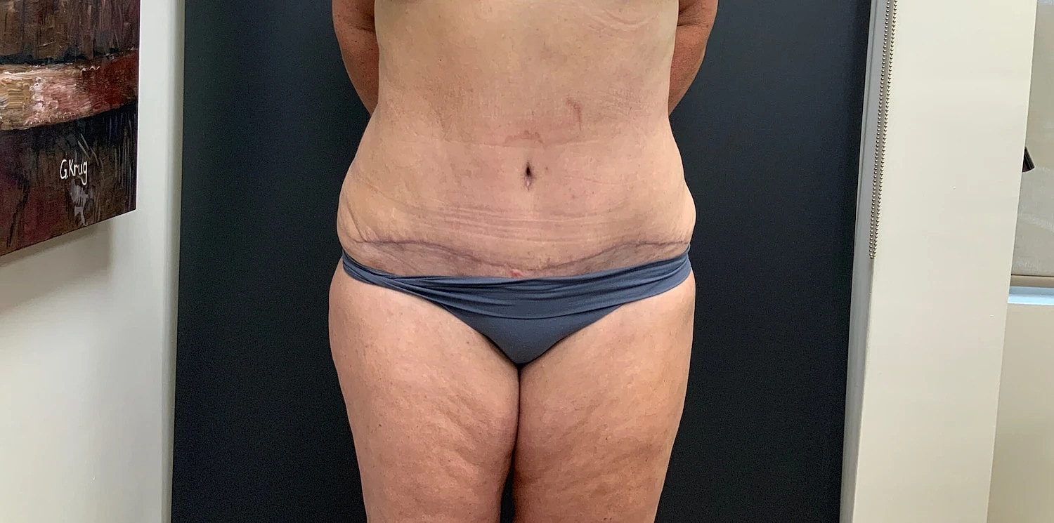Post Weight Loss Before & After