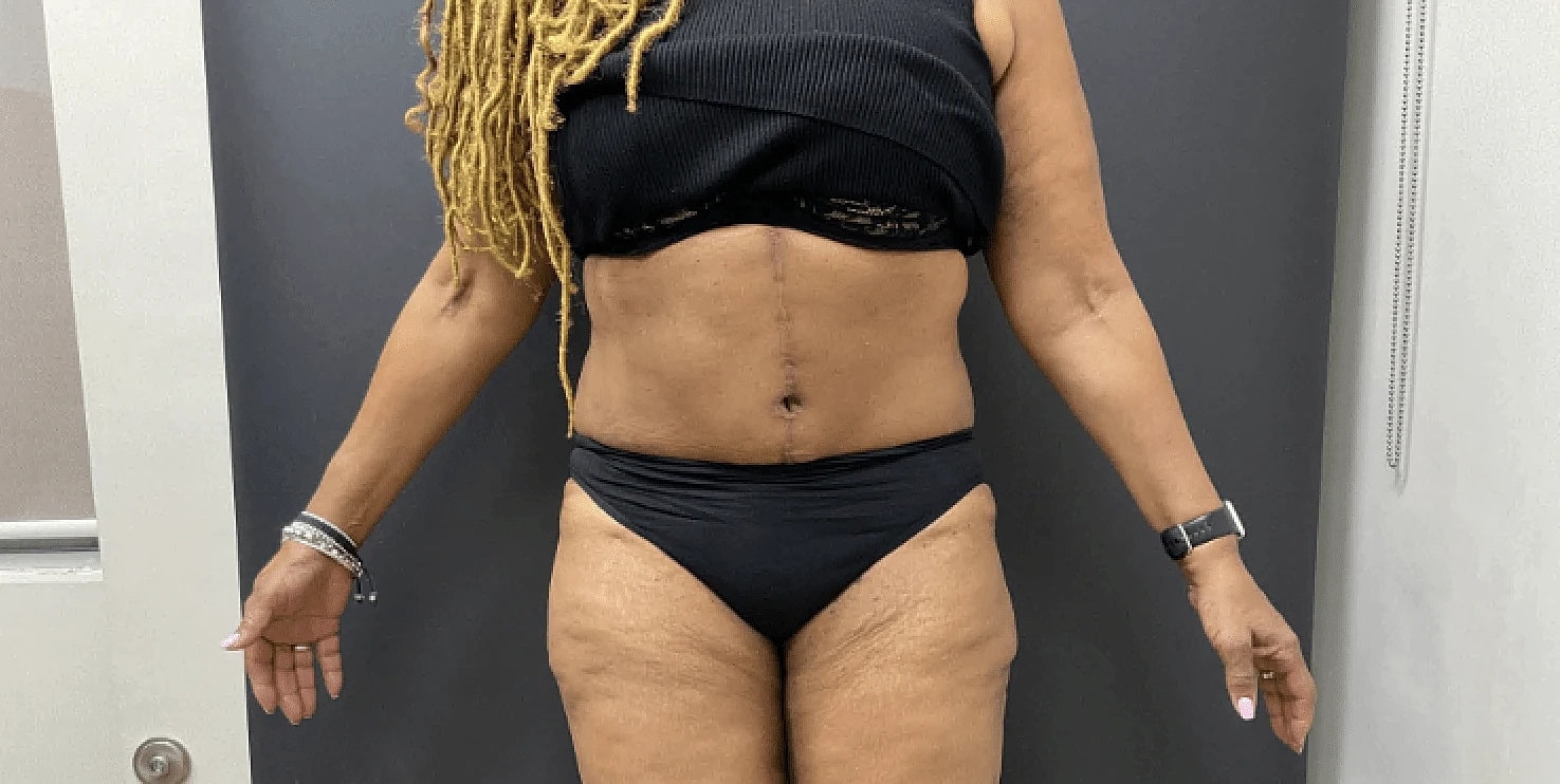 Post Weight Loss Before & After