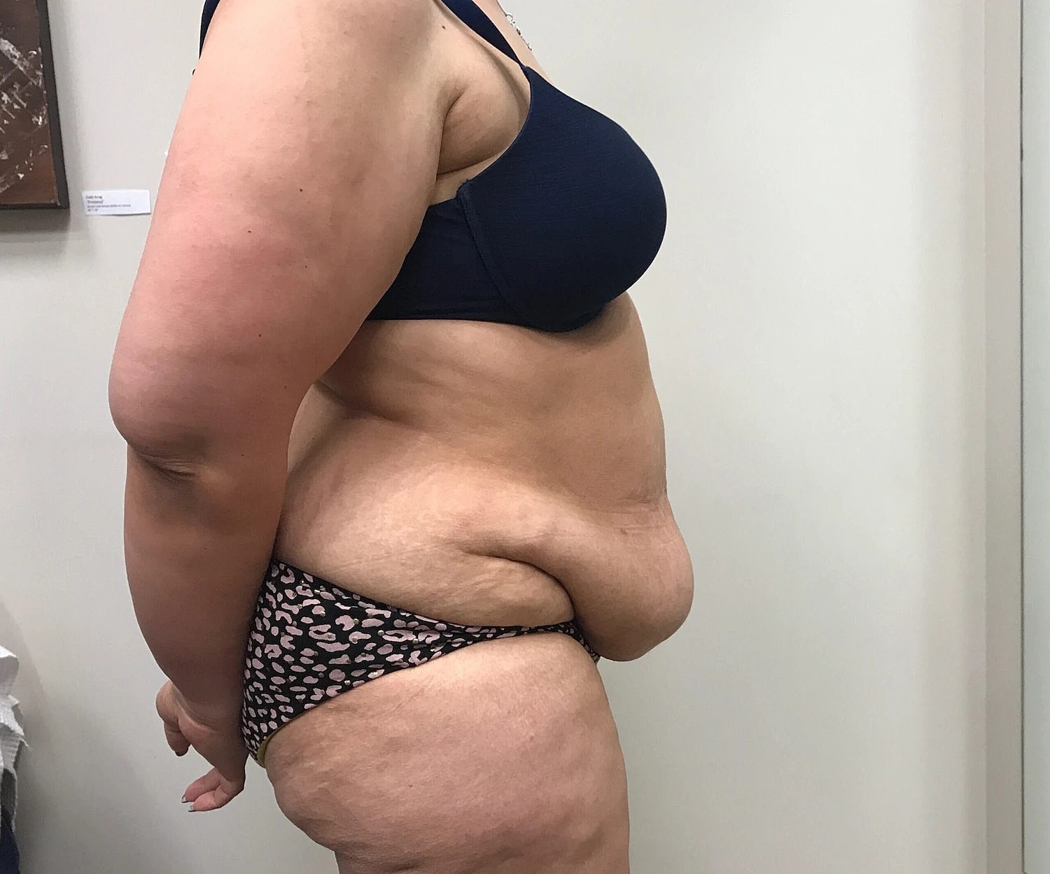 Post Weight Loss Before & After