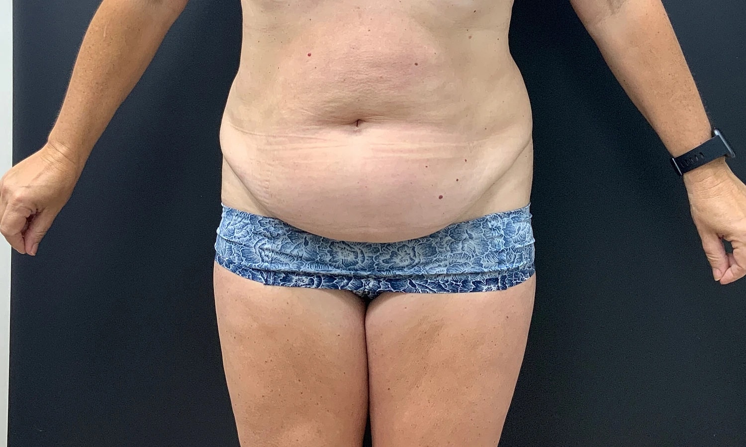 Post Weight Loss Before & After
