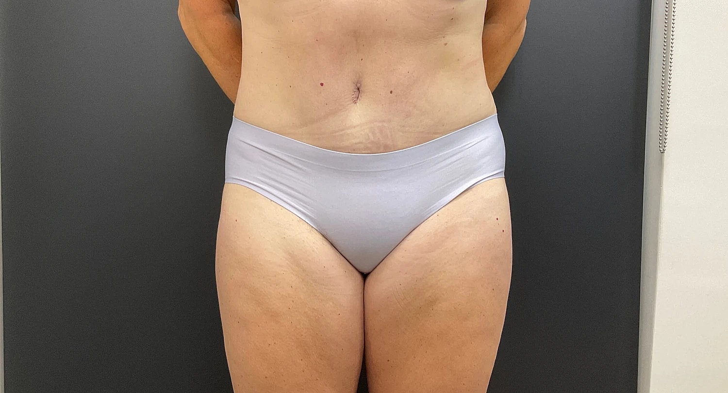 Post Weight Loss Before & After