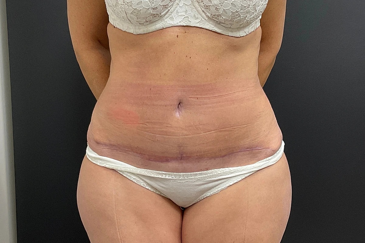 Post Weight Loss Before & After