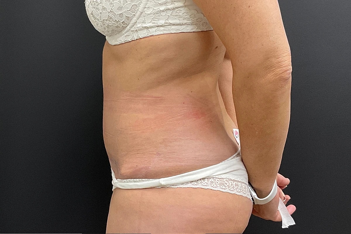 Post Weight Loss Before & After