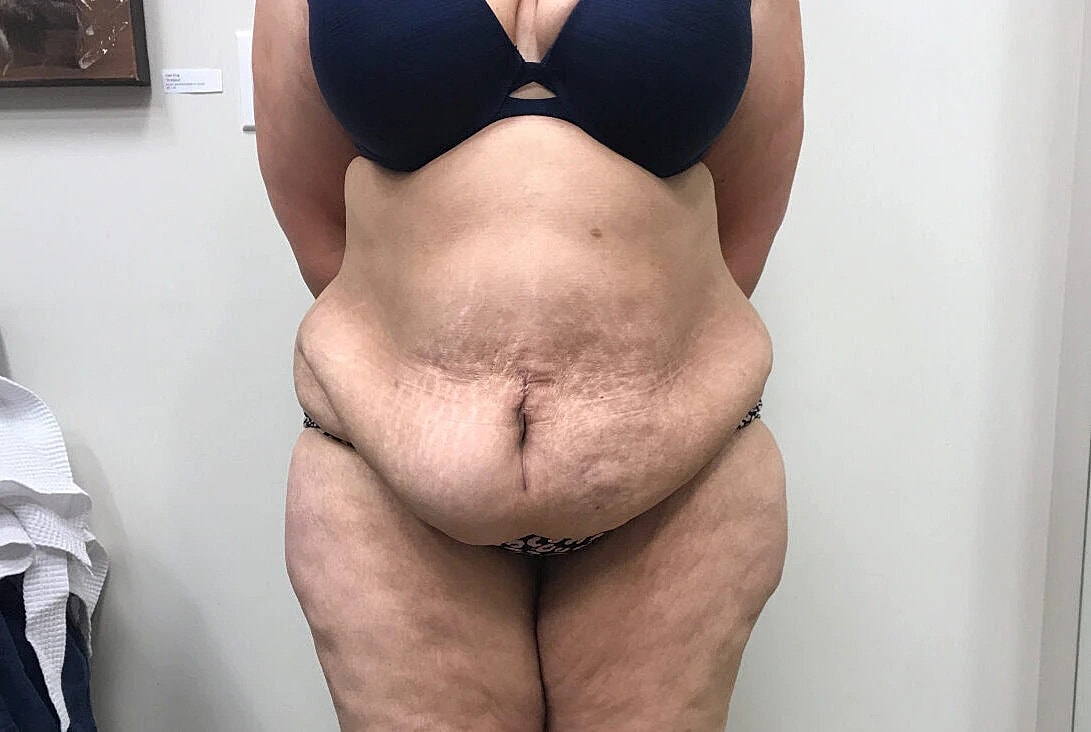 Post Weight Loss Before & After