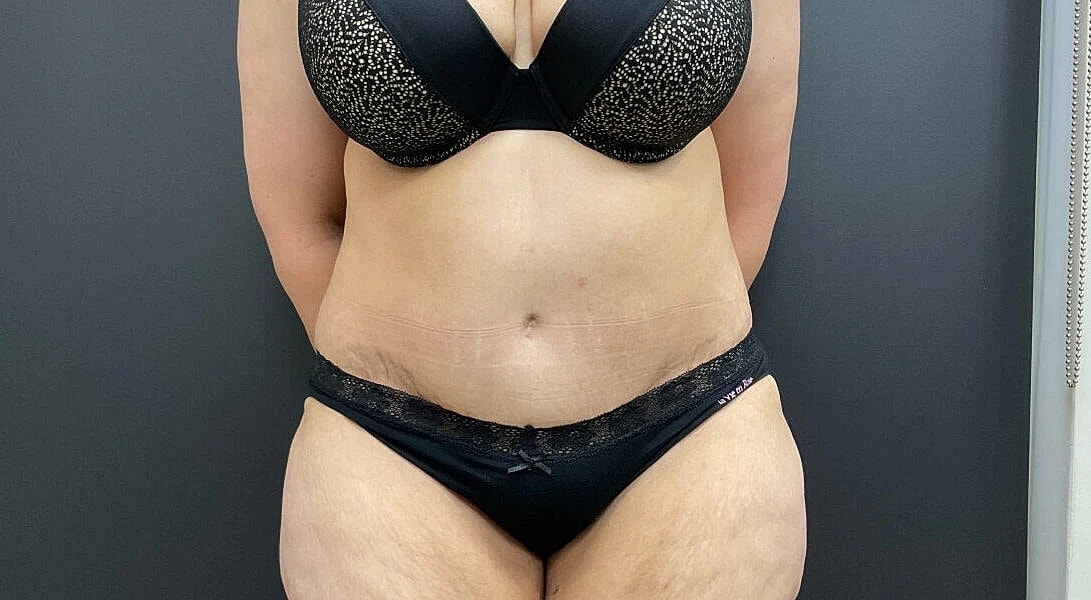 Post Weight Loss Before & After