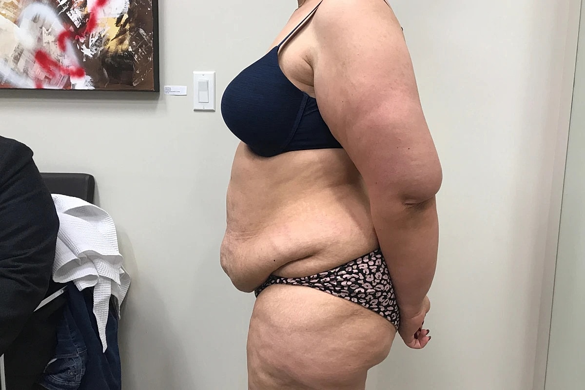 Post Weight Loss Before & After