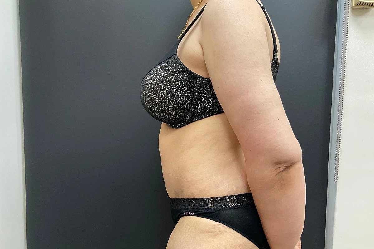 Post Weight Loss Before & After