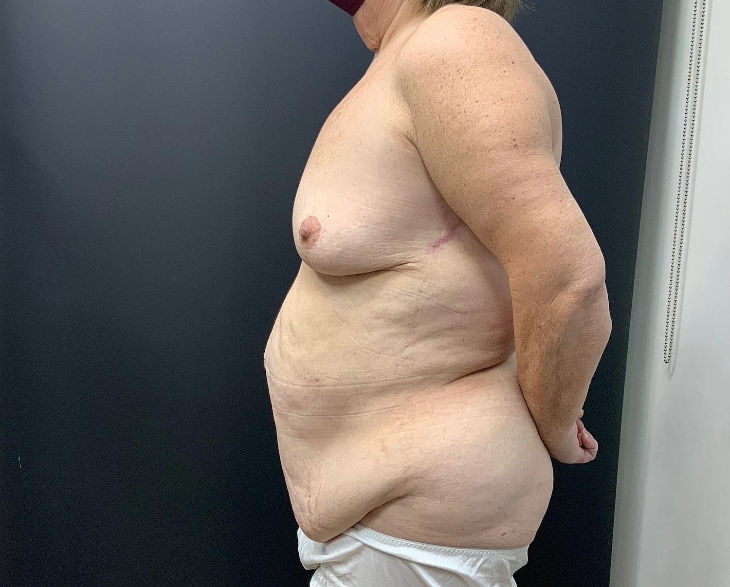 Post Weight Loss Before & After